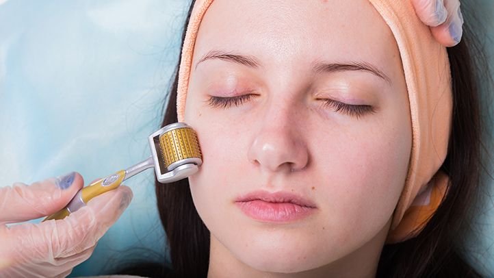 Everything You Need to Know About the Best Microneedling Therapy